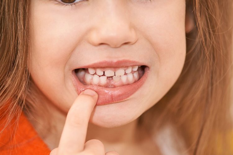 بدجفتی دندان ها در کودکان