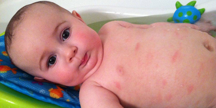 کهیر در کودکان 