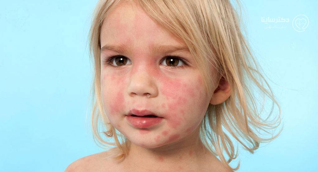  راه درمان کهیر